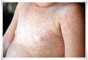 Roseola Rash (Roseola Infantum) – Pictures, Symptoms, Causes and Treatment