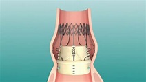 Perceval Sutureless Heart Valve Replacement Implant Animation - YouTube