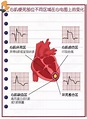 心肌梗死的心电图及临床表现 - 知乎