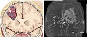 中枢神经系统海绵状血管瘤的诊断和治疗：专家观点和规范推荐_病灶