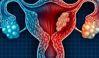Pólipos uterinos