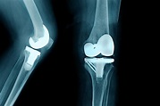 Total Knee Arthroplasty and the Medicare IPO List - MCG Health