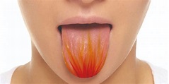 ¿Qué es el síndrome de boca urente? - Blog Salud Bucal