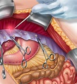 Medical illustrations. Surgeries and devices on Behance