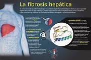 ¿Qué sabes sobre la Fibrosis hepática? | Descubre Fundación UNAM
