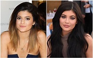 Kylie Jenner After & Before Pictures: Did She Do Surgery? - DemotiX