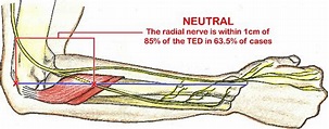 Radial tunnel syndrome causes, symptoms, diagnosis & treatment