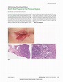 Beefy Red Plaques in the Perianal Region | Dermatology | JAMA ...