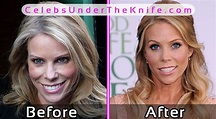 Cheryl Hines Plastic Surgery Before After