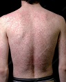 Body rash caused by antibiotic drug - Stock Image - C015/6133 - Science ...