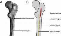 Calcification of the linea aspera: A systematic narrative review ...