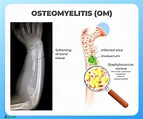 OSTEOMYELITIS (OM) - Symptoms, Causes, Risk Groups, Prevention and ...