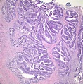 Pathology Outlines - Adenocarcinoma in situ