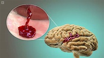 Hemorragia Cerebral: Causas, síntomas y tratamiento | Top Doctors