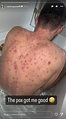 St Johnstone ace Ryan McGowan shares chicken pox pictures