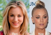 Kaley Cuoco Plastic Surgery Before and After Photos