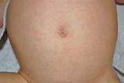 Roseola - Rash, Pictures, Causes, Symptoms, Treatment, Contagious ...