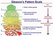 Prostate cancer gleason score