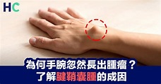 【常見疾病】為何手腕忽然長出腫瘤？了解腱鞘囊腫的成因