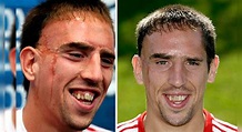 La trágica historia detrás de la cicatriz de Frank Ribery, el crack del ...