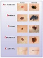 Remember the ABCDEs of Melanoma! | The Eye Associates