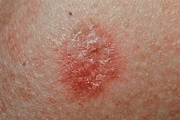 pics of skin cancers - pictures, photos