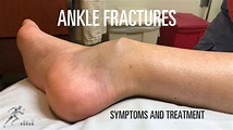 Ankle fracture: Types, signs and symptoms and treatment - YouTube