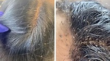 Hair Clinic Remove Hundreds Of Lice From Client's Head - YouTube