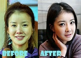 Lee Si Young Plastic Surgery Before and After Pictures - Lovely Surgery