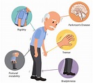 What is Parkinson’s Disease? - SMI - India's First Online Sleep ...