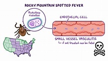 Rocky Mountain spotted fever (RMSF): Nursing - Osmosis Video Library