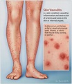 This Patient Page describes vasculitis, focusing especially on skin ...