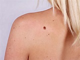 Skin Cancer: 10 Symptoms of Skin Cancer