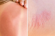 Heat Rash or Sunburn: Here’s How to Tell the Difference | The Healthy