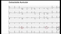 Extrasistole Auricular EKG - YouTube