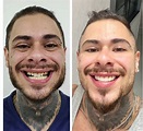 Leo Stronda mostra antes e depois de lentes de contato nos dentes ...