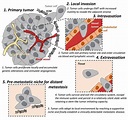 Tumor Invasion and Metastasis | Encyclopedia MDPI