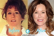 Mary McDonnell Plastic Surgery: Facelift, Botox, Before and After Photos