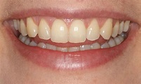 schöne Zähne | Zahnnotizen