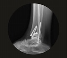 Tratamiento de fractura de tobillo – Doctor Sergio Tejero