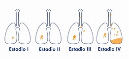 Tipos y estadio de cáncer de pulmón - HC Marbella | HC Marbella ...