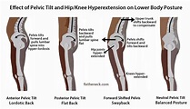 Pelvic Tilt - Manchester-Bedford Myoskeletal LLC | Pelvic tilt ...