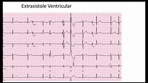 Extrasistole Auricular y Ventricular EKG - YouTube