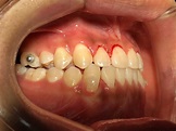 倒及牙箍牙及矯正 - Metro Dental