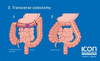 Colorectal resection (colectomy) — Icon Specialist Centre