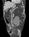 Indirect inguinal hernia | Radiology Reference Article | Radiopaedia.org