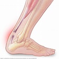 Rotura del tendón de Aquiles - Síntomas y causas - Mayo Clinic
