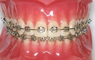 傳統金屬牙箍 - 仁樂牙科中心