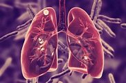 ¿Qué es la tuberculosis pulmonar y cuáles son sus síntomas? - Mejor con ...