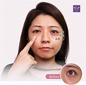「五合一隱痕眼袋手術」–眼袋淚溝一次解決，同步修飾黑眼圈 | 佳思優整形醫美診所